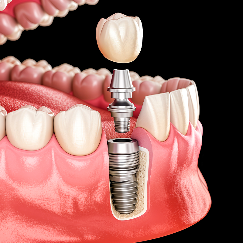 Esquema detalhado de um implante dentário: coroa, pilar e parafuso de titânio integrados ao osso