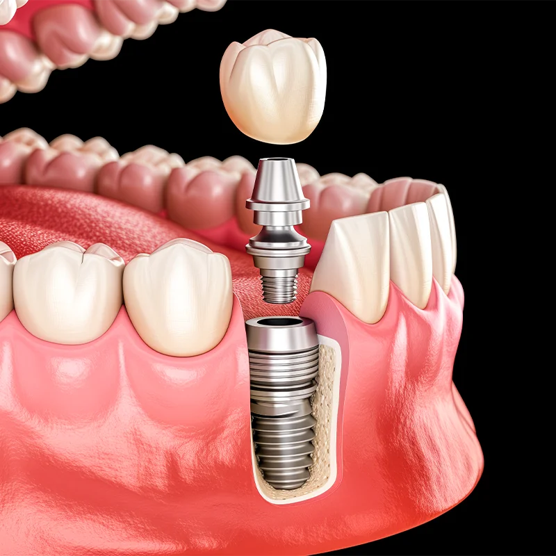 Esquema detalhado de um implante dentário: coroa, pilar e parafuso de titânio integrados ao osso