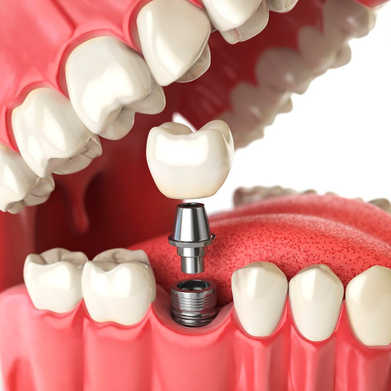 Implante Dentário