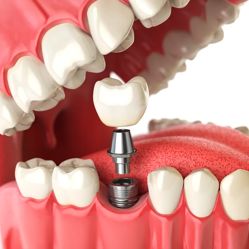Implante Dentário